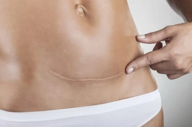 C Section Scar Treatment.jpg