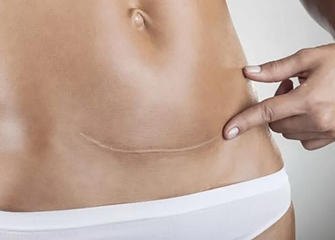C-Section Recovery  Image