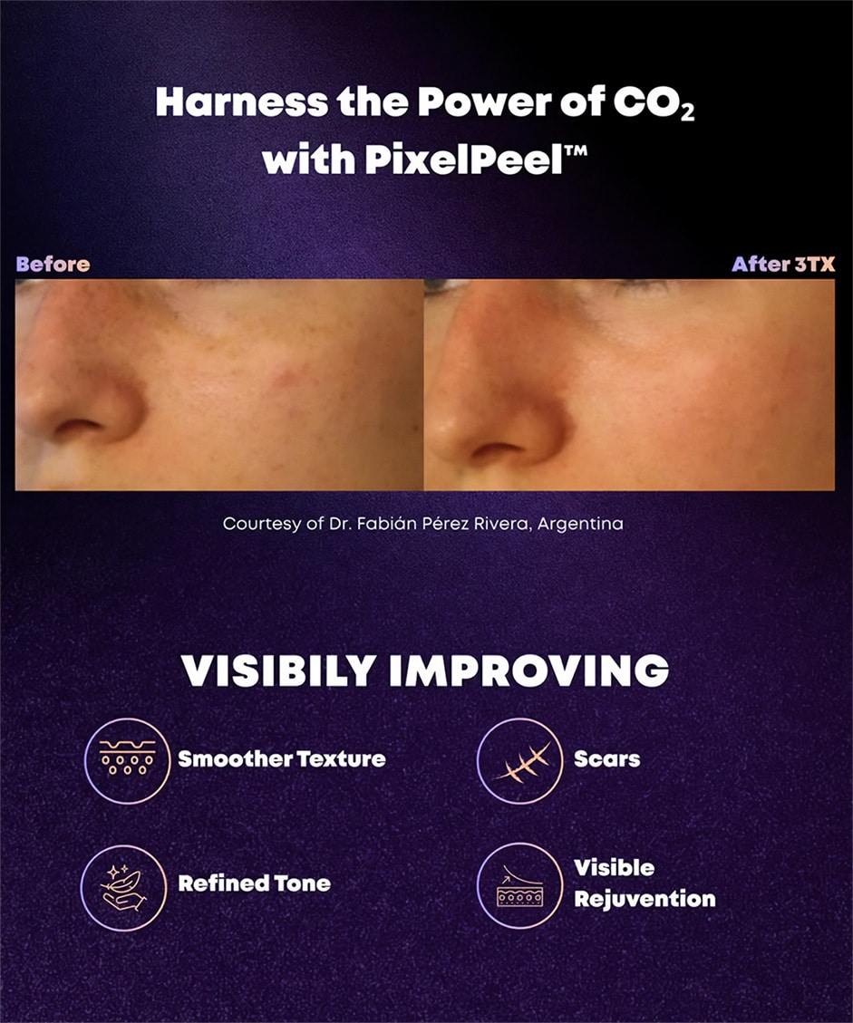 Alma Pixel CO2 - Future Clinic